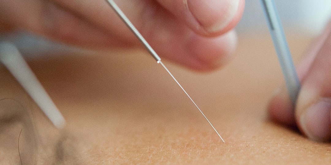 Acupuncture and Traditional Chinese Medicine